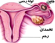 حاملگی خارج از رحم حاملگی خارج از رحم