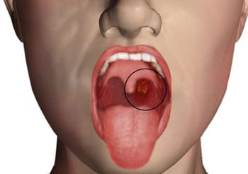 سرطان دهان چیست و چگونه به وجود می آید؟