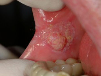 سرطان دهان چیست و چگونه به وجود می آید؟
