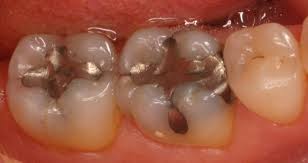 چرا دندانمان پوسیده می شود و با پوسیدگی دندان چه کنیم