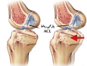 آسیب و پارگی رباط صلیبی قدامی ACL در مفصل زانو علائم و درمان آن