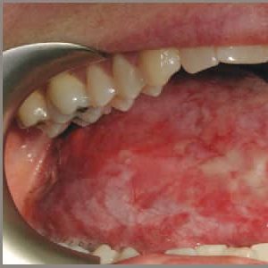 سرطان دهان با نمای اریترولکوپلاکیا