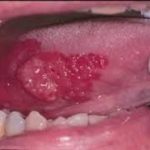 سرطان دهان‌با نمای ضایعات برجسته یا اگزوفیتیک