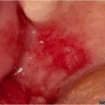 سرطان دهان‌ با نمای قرمز رنگ یا اریتروپلاکیا