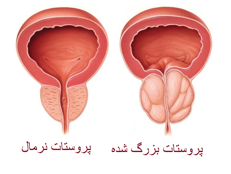 روش های درمان خانگی پروستات متورم روش های درمان خانگی پروستات متورم