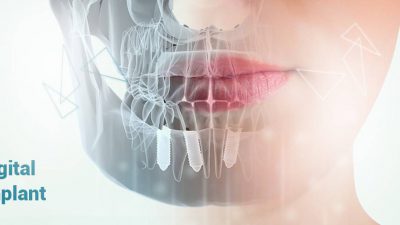 آیا می خواهید درباره ایمپلنت دیجیتال ، جدیدترین تکنولوزی کاشت دندان بدانید ؟
