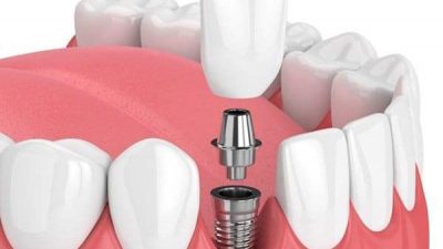 مراحل ایمپلنت دندان از جراحی تا قالب گیری