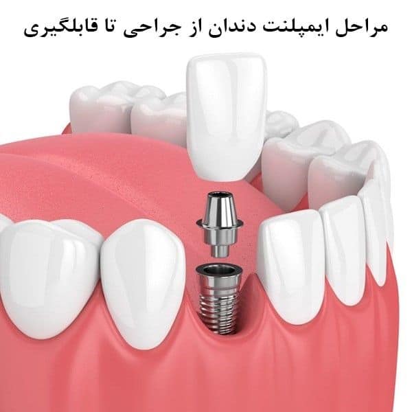 مراحل ایمپلنت دندان از جراحی تا قالب گیری