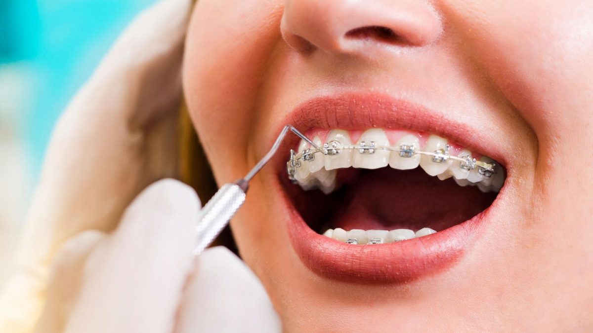 تفاوت های سیم کشی دندان به صورت یک فک  و دو فک