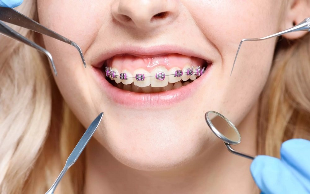 سیم کشی دندان برای بهبود ظاهر لبخند