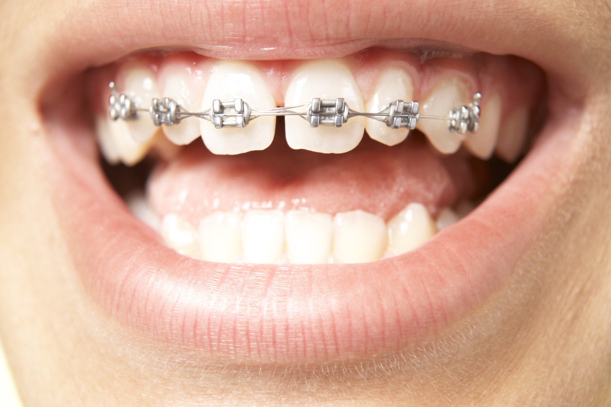 سیم کشی دندان برای یک فک نیز قابل انجام است