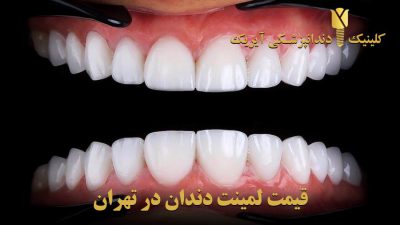قیمت لمینت و کامپوزیت دندان 1402
