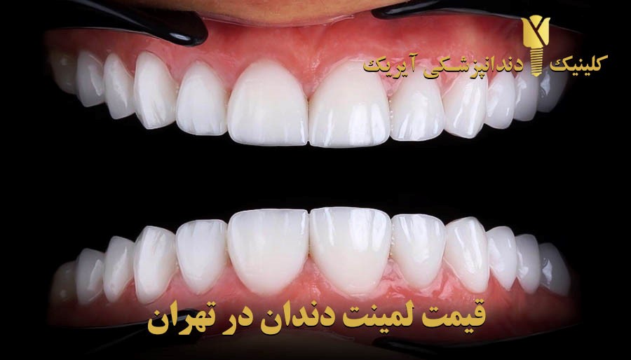 قیمت لمینت و کامپوزیت دندان 1402
