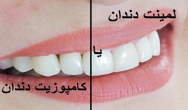 تفاوت لمینت دندان و کامپوزیت دندان