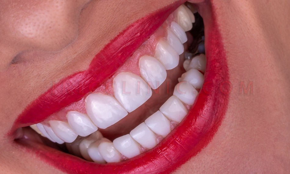 عکس کامپوزیت دندان