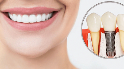 کاشت دندان چیست؟ معرفی انواع کاشت دندان