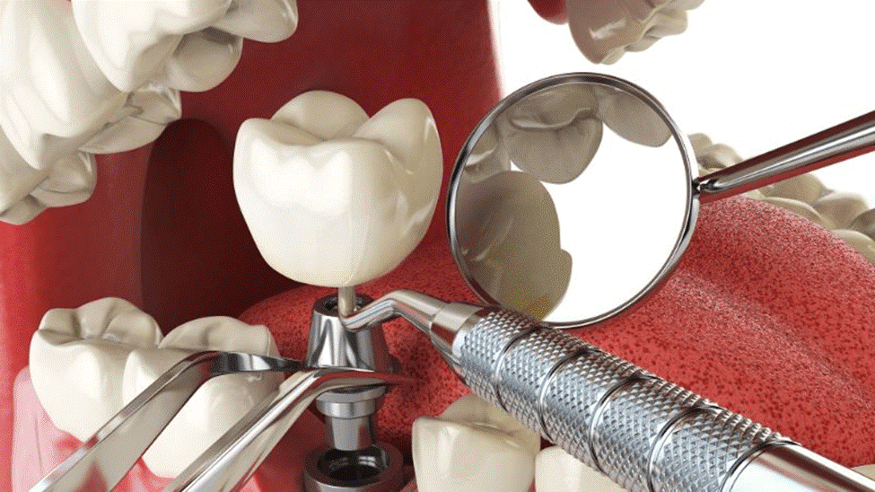 کاشت دندان چیست؟ معرفی انواع کاشت دندان
