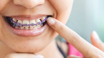 آیا ارتودنسی موجب لق شدن دندان می‌شود؟