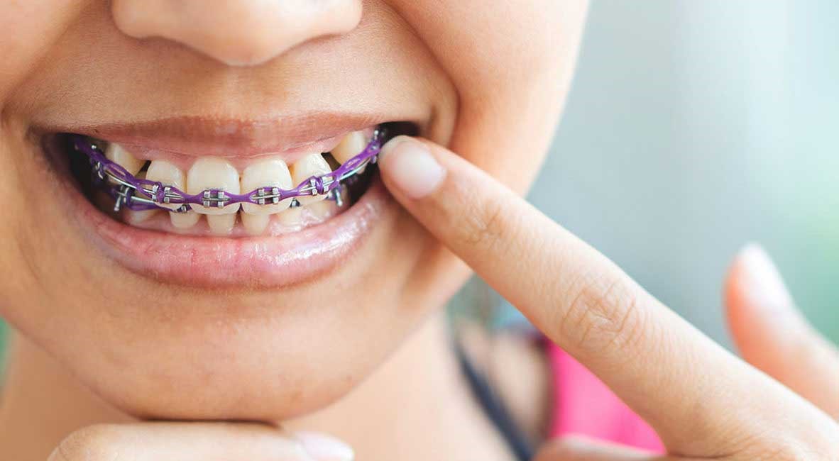 آیا ارتودنسی موجب لق شدن دندان می‌شود؟
